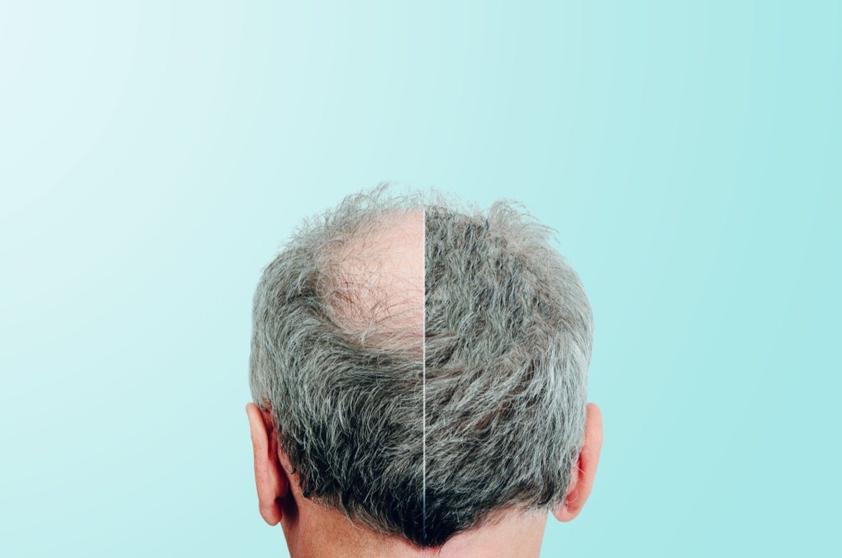 Hair Regrowth Treatments: From Medications and Lasers to Modern Hair Transplants